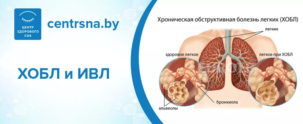 Обструктивная недостаточность легких. Хроническая обструктивная болезнь легких (ХОБЛ). Хронические обструктивные заболевания лёгких. При хронической обструктивной болезни легких.