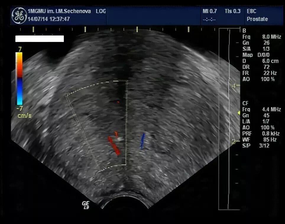 Аденома простаты по УЗИ. УЗИ простаты инструмент.