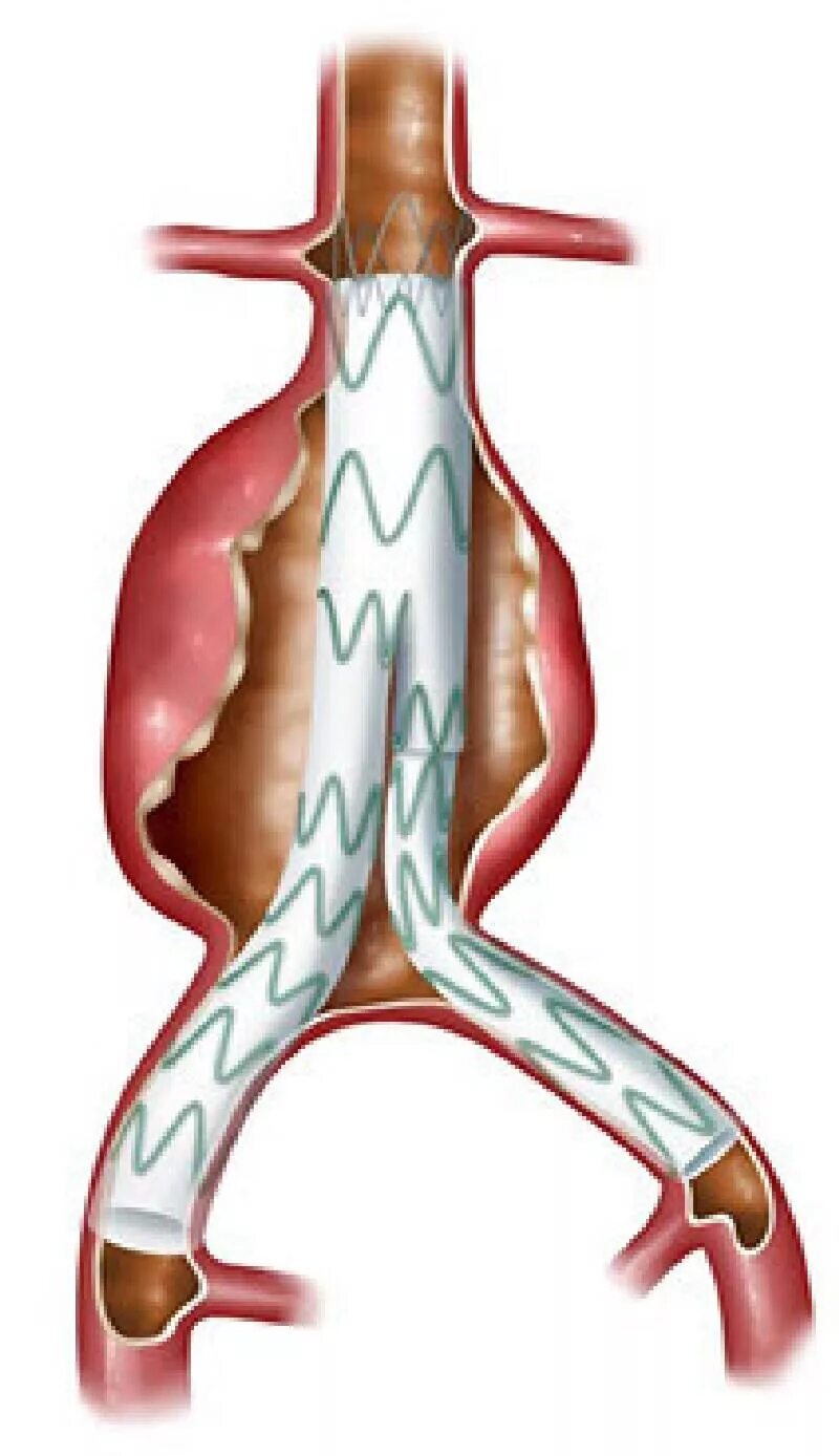 Аневризма стент. Стент графт брюшной аорты. Стент графт аневризма брюшной аорты. Стент графт при аневризме брюшной аорты. Эндоваскулярное стентирование брюшной аорты.