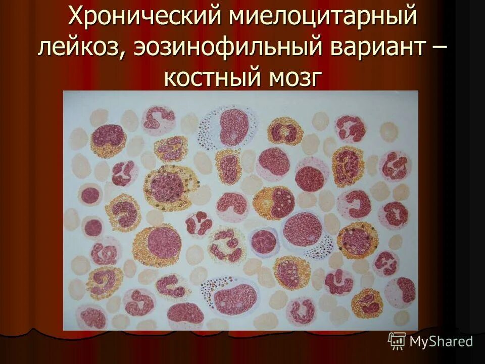 Метастазы при лейкозе. Острые нелимфобластные лейкозы. Хронический миелобластный лейкоз мазок крови. Миелограмма костного мозга хронический лимфолейкоз. Метастазы при лейкозе.