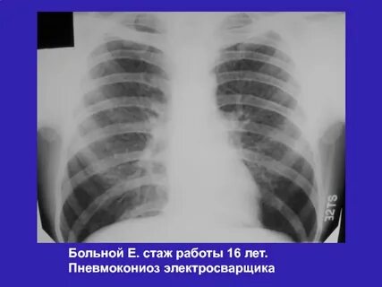 Пневмокониоз