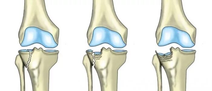 Повреждение мыщелка. Перелом наружного мыщелка большеберцовой кости. Перелом мыщелков большеберцовой кости. Перелом мыщелка берцовой кости. Перелом мыщелка берцовой кости коленного сустава.