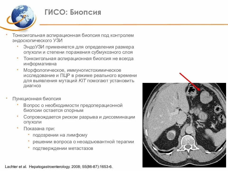 Гастроинтестинальная опухоль. Гастроинтестинальная стромальная опухоль желудка на кт. Стромальная опухоль (Gist),. Стромальные опухоли ГИСО.