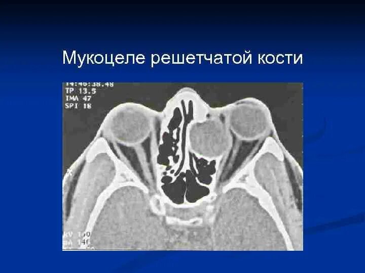 Мукоцеле решетчатого Лабиринта мрт. Мукоцеле ячеек решетчатого Лабиринта. Мукоцеле ячеек решетчатого Лабиринта кт. Мукоцеле решетчатой кости на кт. Утолщение слизистой оболочки решетчатых лабиринтов