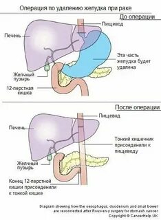 Удаление желудка сколько живут