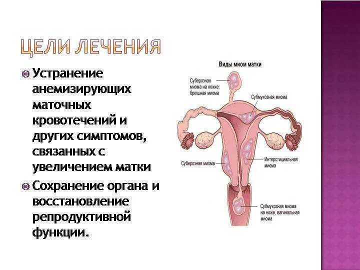 Формы миомы матки. Миома матки гинекология. Интерстициальная миома матки что это такое. Симптомная миома матки.