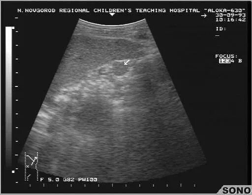 Дополнительная долька селезенки на УЗИ. УЗИ картина добавочной дольки селезенки.
