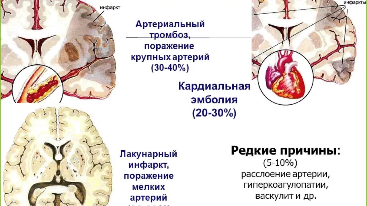 Инфаркт мозга неуточненный. Инфаркт головного мозга классификация. Транзиторная ишемическая атака этиология. Ишемический инсульт. Этиология. Клиника. Лечение. Патогенез инфаркта головного мозга.