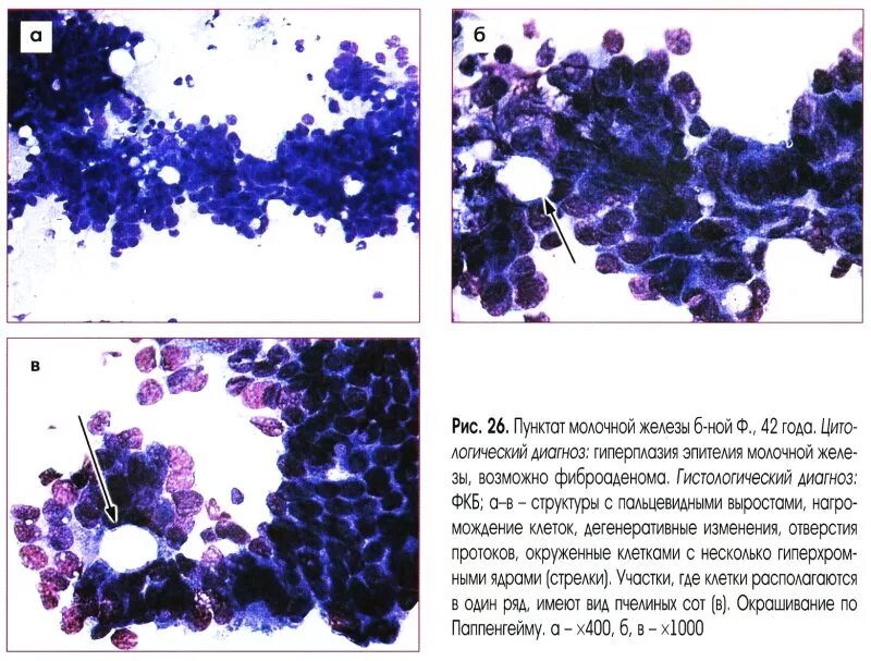Цитологическое исследование пунктата. Цитологическое исследование пунктата опухоли молочной железы. Цитологическое исследование фиброаденомы молочной железы. Цитология пунктата молочной железы. Фиброаденома молочной железы цитология.