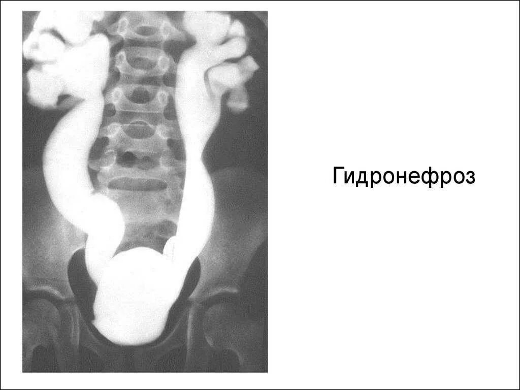 Гидронефроз 1 степени. Нерефлюксирующий мегауретер. гидронефроз почки рентген. двусторонний гидронефроз на кт. нейромышечная дисплазия мочеточника.