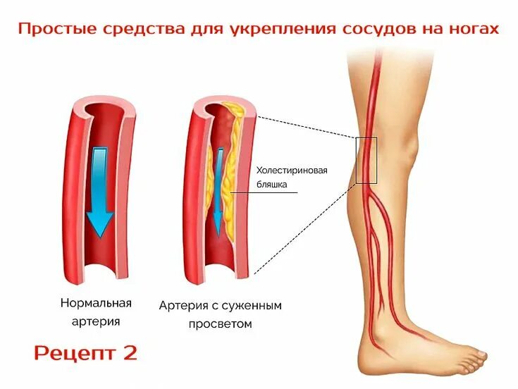Облитерирующий атеросклероз артерий нижних конечностей. Атеросклероз сосудов нижних конечностей. Атеросклероз сосудов конечностей.