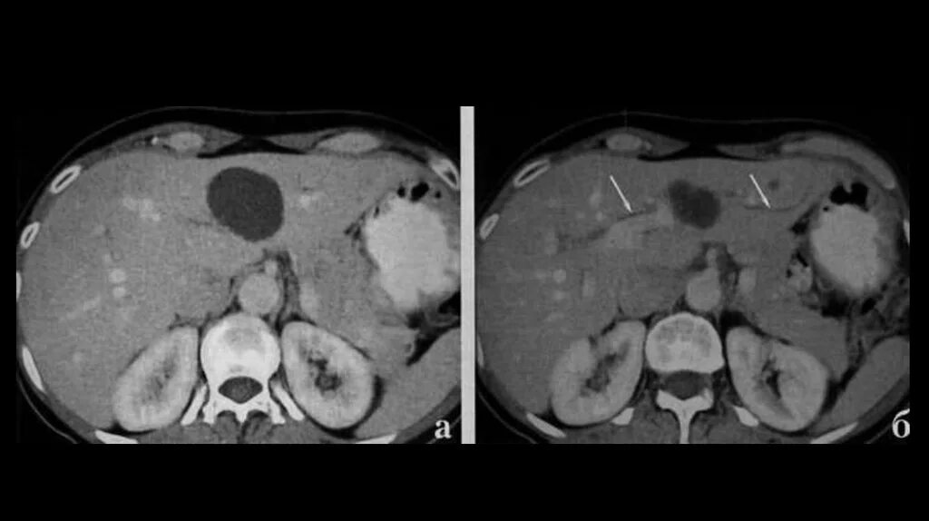 Билиарные кисты печени кт. Расширены внутрипеченочные желчные протоки на кт. Обызвествленная киста печени кт. Дилатация желчных протоков кт. Киста печени форум