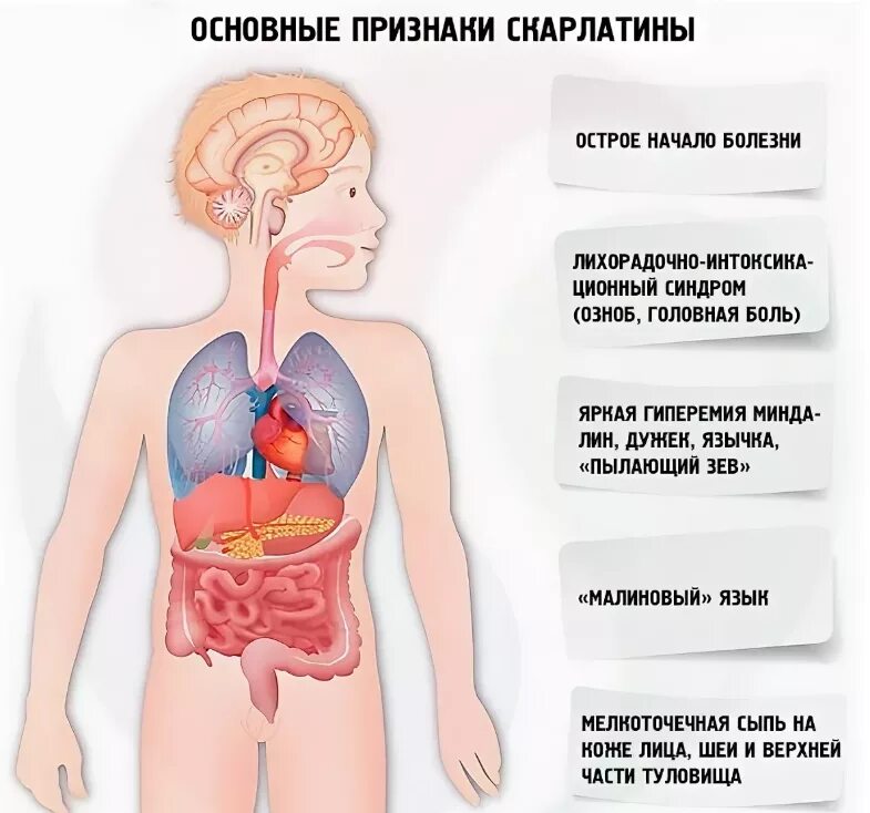 Скарлатина у детей симптомы. Данное заболевание также