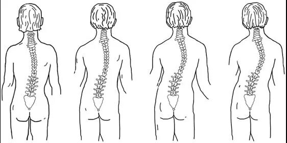 Сколиоз 2 степени угол искривления. Сколиоз 1 степени. Сколиоз 3 степени угол искривления. Правосторонний сколиоз 2 степени.