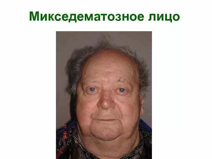 Гипотиреоз у пожилых. Заболевания в пожилом возрасте. Гипотиреоз у пожилых лечение. Микседема болезнь симптомы. Пострадиационный гипотиреоз.