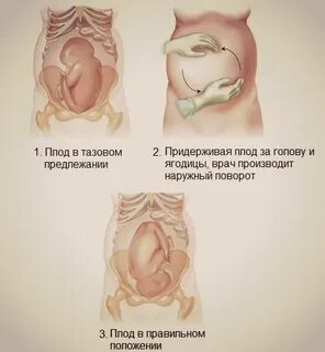 27 неделя тазовое предлежание