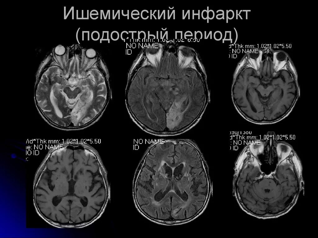 Инфаркт мозга причины. Ишемический инфаркт головного мозга. Подострый период инфаркта мозга. Причины ишемического инфаркта.