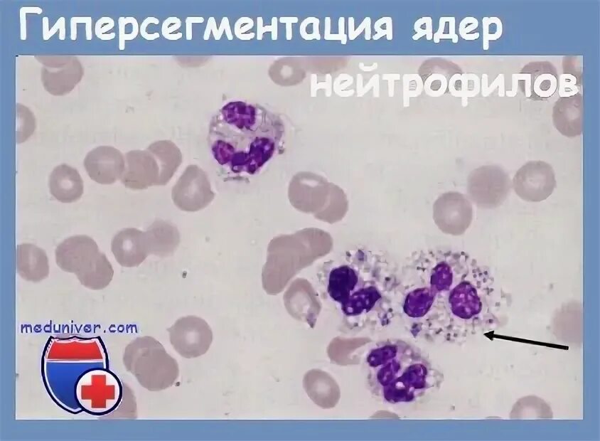 Гиперсегментация ядер нейтрофилов. Полисегментация нейтрофилов. гиперсегментация ядер лейкоцитов. гиперсегментация ядер и полисегментация нейтрофилов.