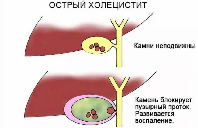 Мукоцеле желчного пузыря. Острый билиарный холецистит. Острый холецистит желчного пузыря. Холецистит воспаление желчного пузыря. Хронический калькулезный холецистит.