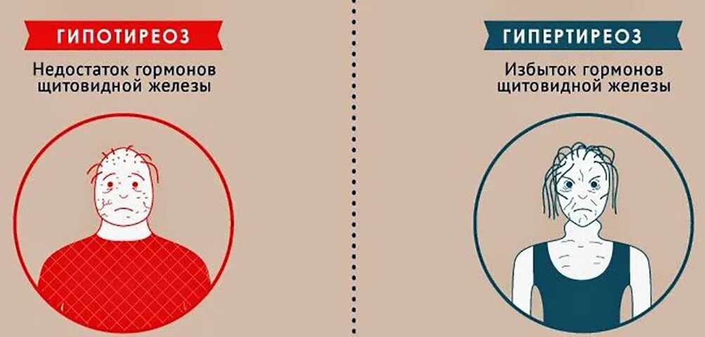 Недостаток гормонов щитовидной железы (гипотиреоз) приводит. Болезни избытка и недостатка гормонов щитовидной железы. Недостаток гармоно в щитовидной железы. Гипотиреоз и гипертиреоз щитовидной железы. Как жить без щитовидной железы