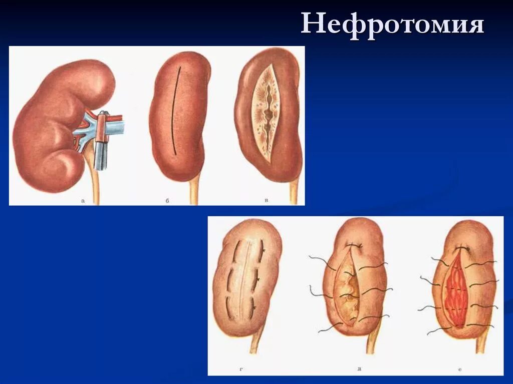 Нефротомия. Нефротомия. Нефротомия. Оперативная хирургия почек нефротомия. Нефротомия.