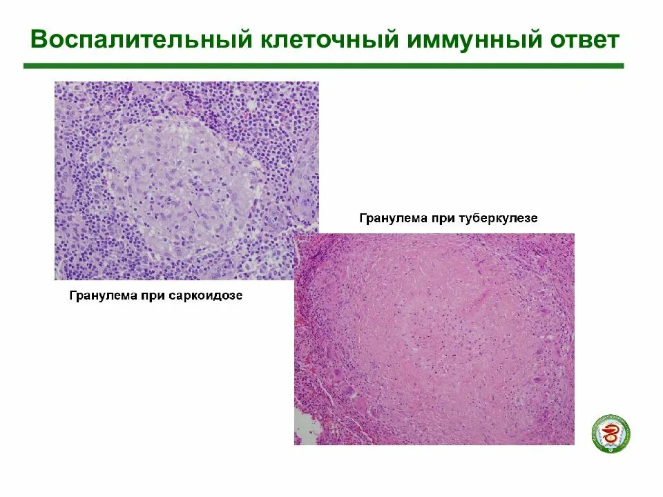 Клетки воспалительной реакции