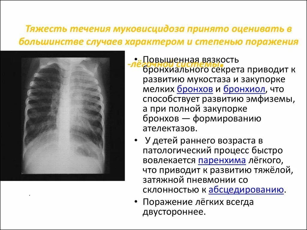 Хронического муковисцидоза. Фиброз панкреатит поджелудочной железы. Муковисцидоз патогенез. Лечение муковисцидоза клинические рекомендации. Хронического муковисцидоза.