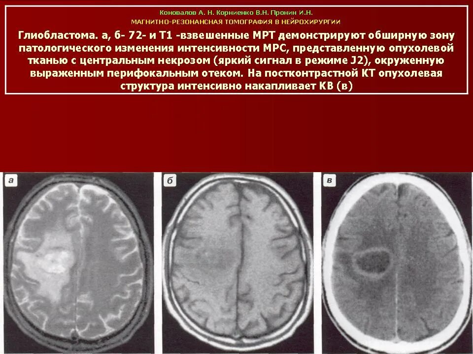 Глиобластома мозга симптомы. Опухоль головного мозга глиобластома 4. Глиобластома лобно височной доли. Глиобластома головного мозга мрт.