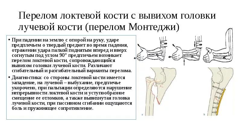 Сколько времени болят переломы. Перелом Монтеджи остеосинтез. Перелом лучевой кости с вывихом головки локтевой кости. Перелом с вывихом головки лучевой кости. Перелом головки локтевой кости.