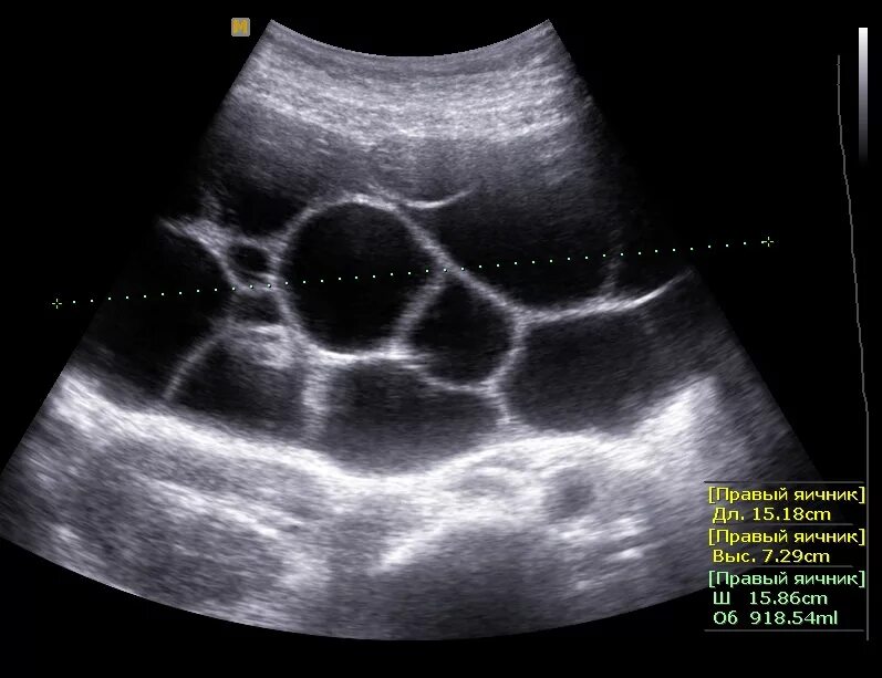 Многокамерная киста яичника на УЗИ. Текалютеиновая киста яичника УЗИ. Текалютеиновые кисты на УЗИ. ТЕКА лютеновые кисты яичников.