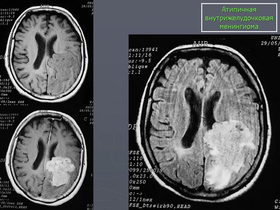 Кальцинированная менингиома на кт. Нейрофиброма головной мозг мрт. Анапластическая менингиома кт. Анапластическая (злокачественная) менингиома. Атипическая менингиома.