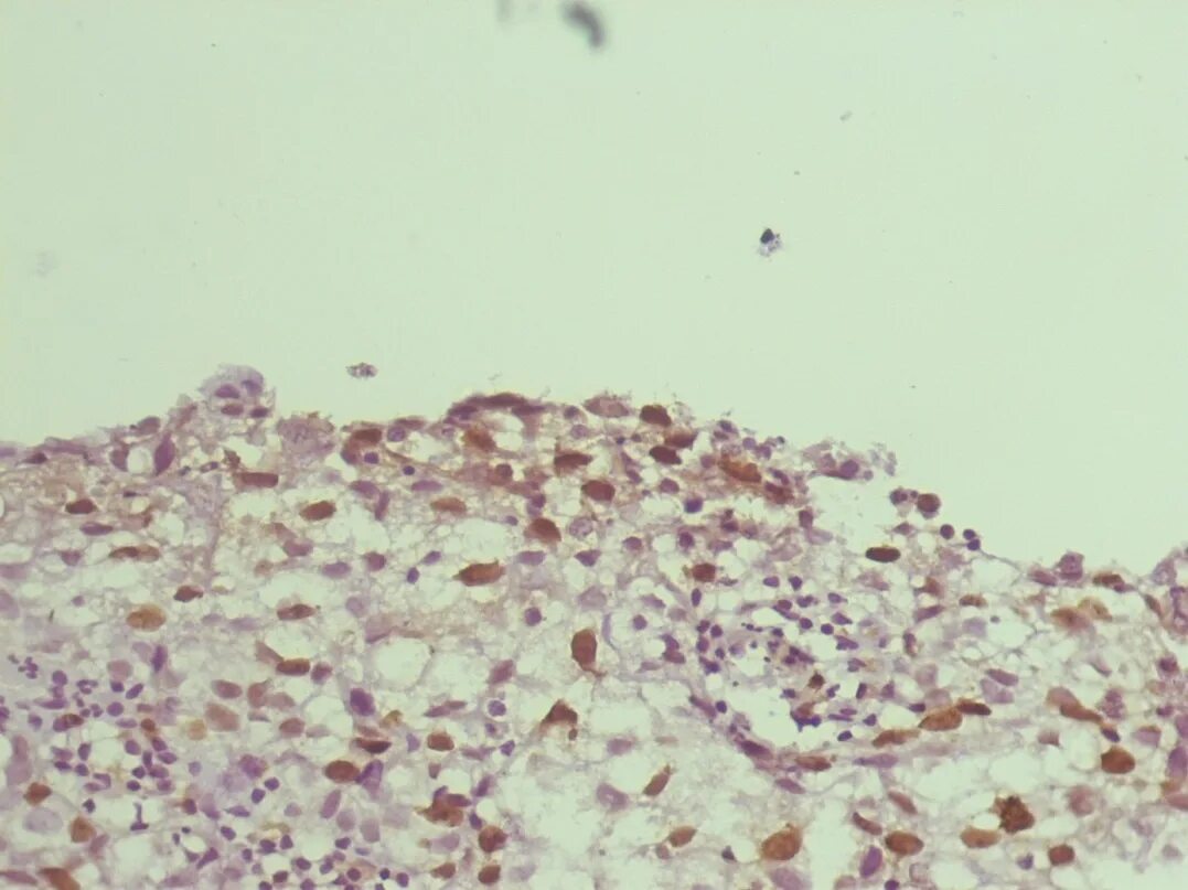 Умеренно выраженная экспрессия. Her2 негативный. Опухоль экспрессирующая p40. Экспрессия в онкологии. Секреция цитокинов.