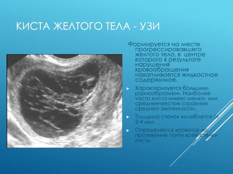 Какая норма кисты. Структура кисты желтого тела на УЗИ. Киста желтого тела яичника на УЗИ. Киста жёлтого тела с кровоизлиянием на УЗИ. Жёлтое тело в яичнике на УЗИ.