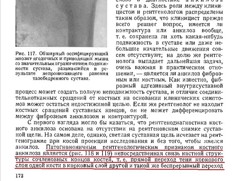 Анкилоз тазобедренного сустава. Анкилоз тазобедренного сустава