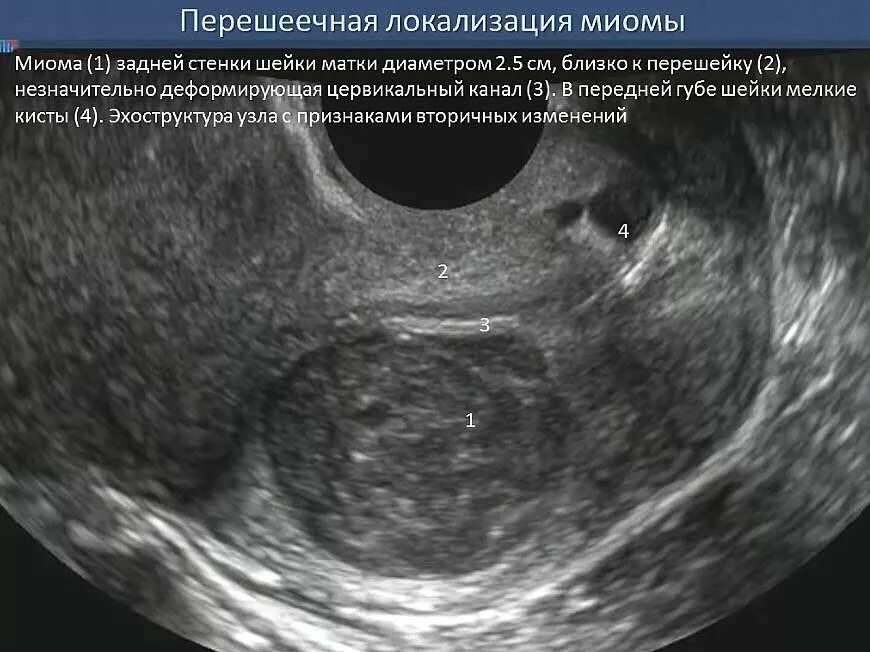 Матка 37 мм. Шеечная локализация миомы. Шеечный миоматозный узел.