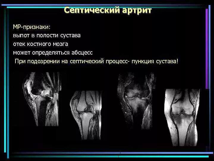 Выпот в полости коленного сустава. Септический артрит коленного мрт. Рентгенодиагностика артрита коленного сустава. Выпот в коленном суставе мрт. Реактивный артрит коленного сустава мрт.