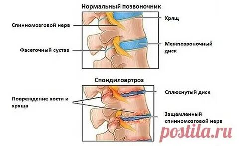 Симптомы грудного спондилеза у женщин