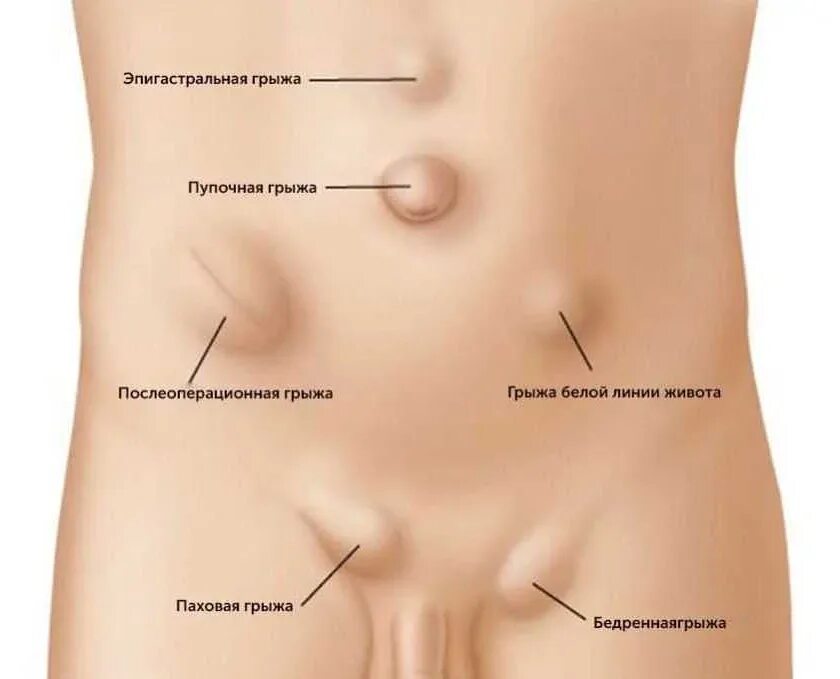 Паховая грыжа что можно кушать. Грыжа спигелиевой линии. паховая грыжа и пупочная грыжа симптомы. признаки спигелиевой грыжи.