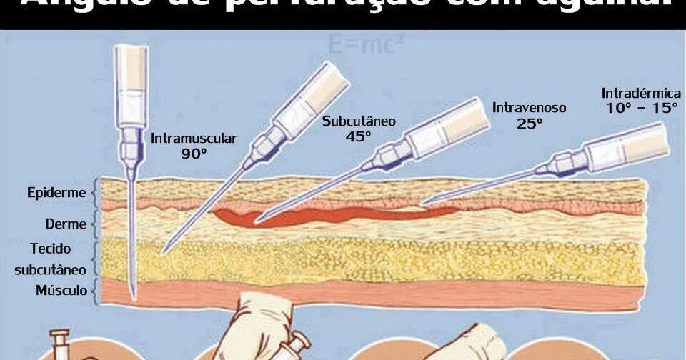 схема подкожного введения уколов. внутрикожная инъекция игла вводится. внутрикожная инъекция глубина иглы. введение иглы при внутрикожной инъекции. укол подкожно инсулиновым шприцом.