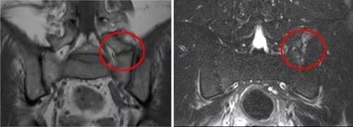 Сакрализация l5 люмбализация s1. Сакрализация l6. Сакрализация l5 позвонка. Сакролизация l 5 позвонка. Неполная сакрализация l5 позвонка рентген.