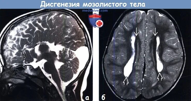 Очаги в мозолистом теле. Мозолистое тело анатомия кт. Агенезия мозолистого тела мрт. Мозолистое тело анатомия мрт. Мозолистое тело анатомия кт.