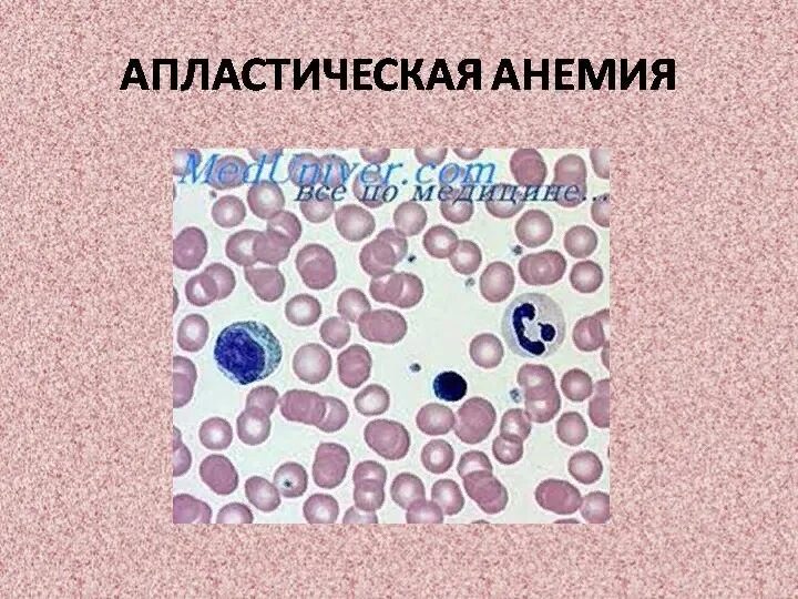 Гипопластическая анемия картина крови. Апластическая анемия костный мозг. Картина крови апластической анемии. Гипо и апластическая анемия.