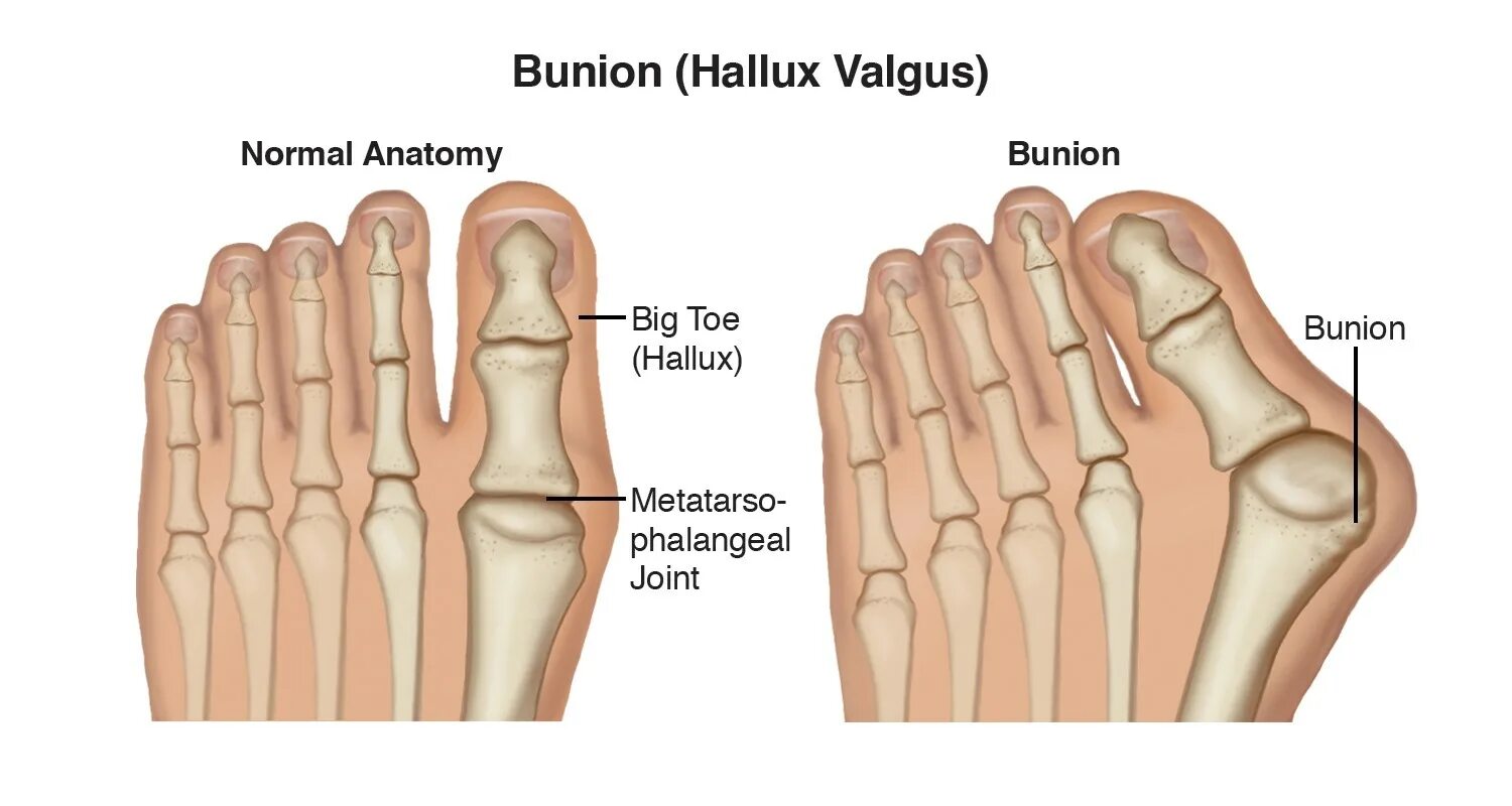 Hallux valgus степени рентген. Халюкс вальгус рентген. Hallux valgus что это