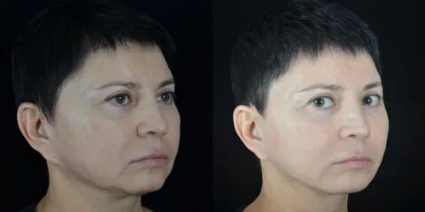 Коррекция осложнений