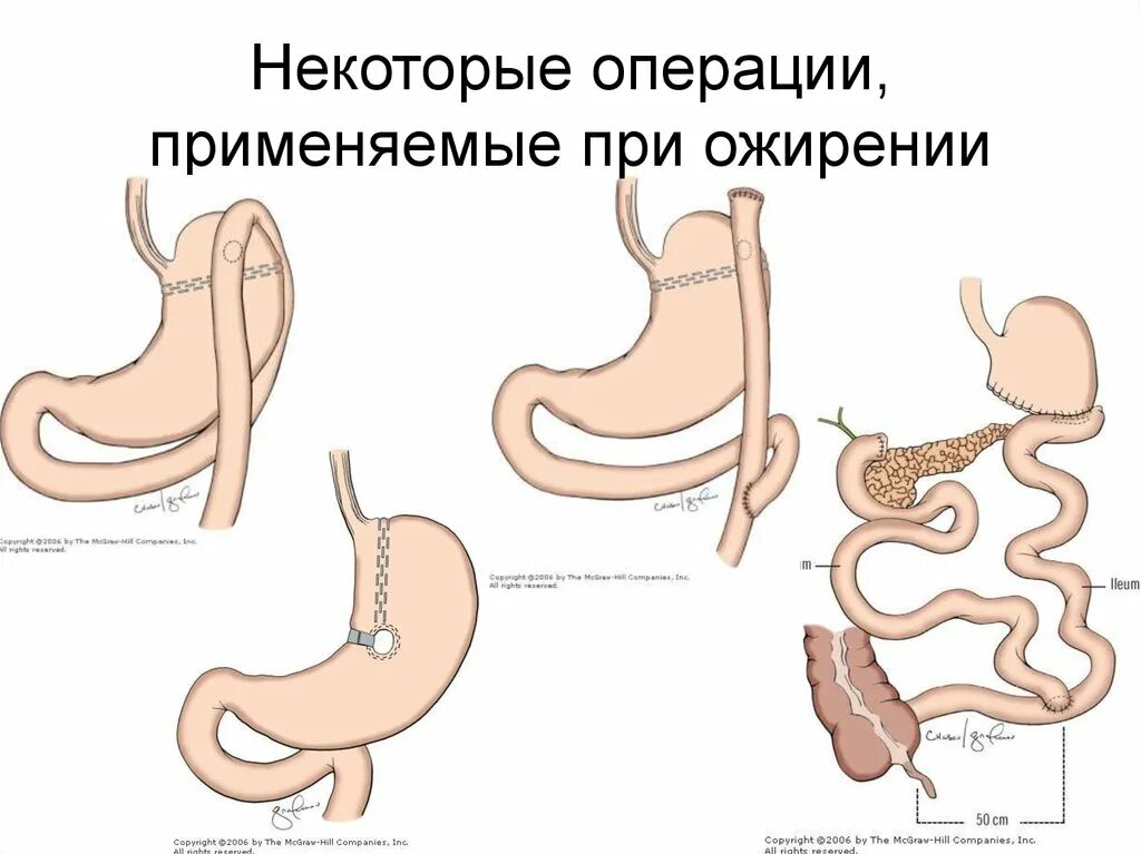 Последствия операции желудка. Бариатрическая операция на желудке. Бариатрическая операция при ожирении. Бариатрия резекция желудка. Бариатрическая хирургия при ожирении.