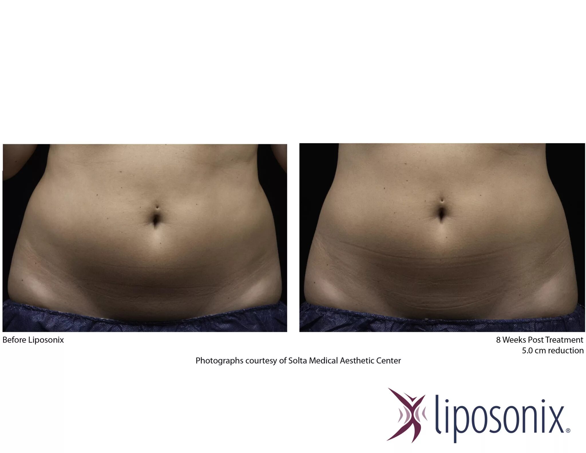 кавитация и липосоникс что это. женский гормональный живот. женский гормональный живо. живота 45. девушки с жирком.