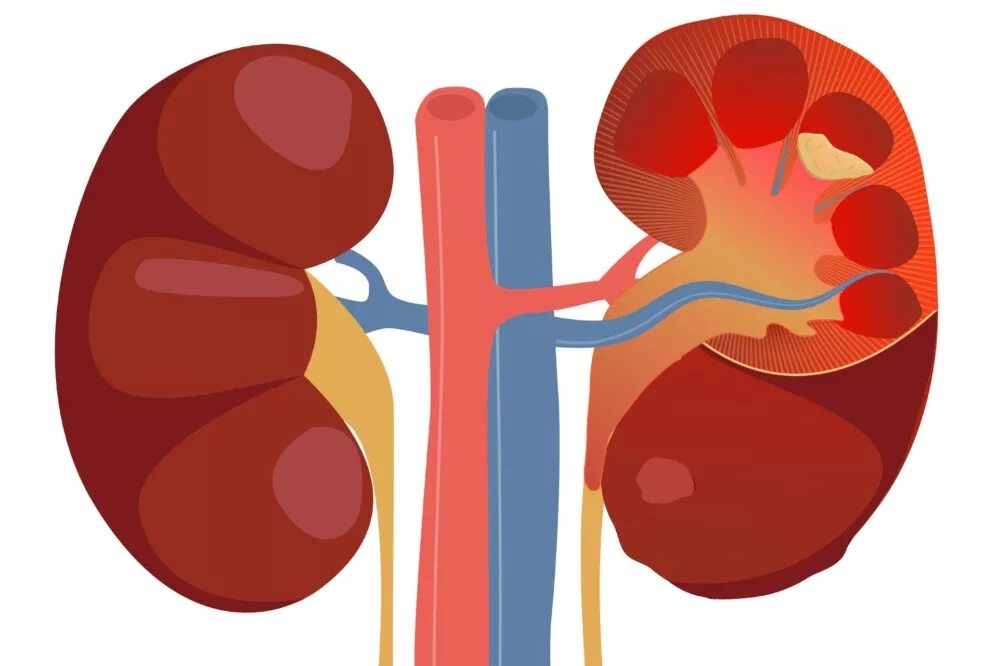 Здоровая и нездоровая почка. Здоровые и больные почки. Хроническое поражение почек