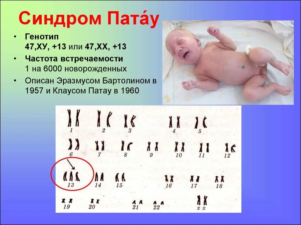 Хромосомные болезни синдром Патау. Синдром Патау или трисомия по 13 хромосоме. Синдром Патау набор хромосом. Трисомия хромосомы 13 симптомы.