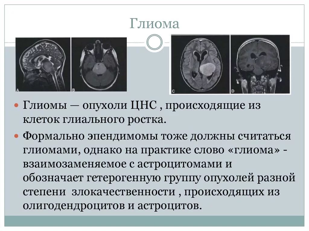 Глиома лечение. Степени злокачественности глиом. Глиальная опухоль головного мозга.