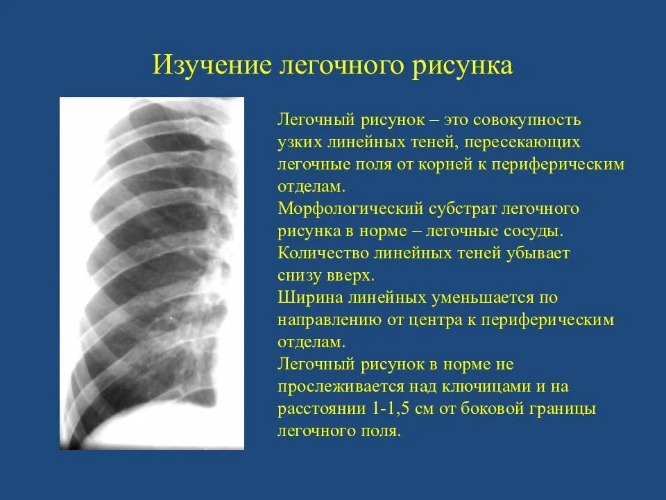 Легочный рисунок. Патология легочного рисунка. Сетчатая деформация легочного рисунка. Усиленный легочный рисунок.